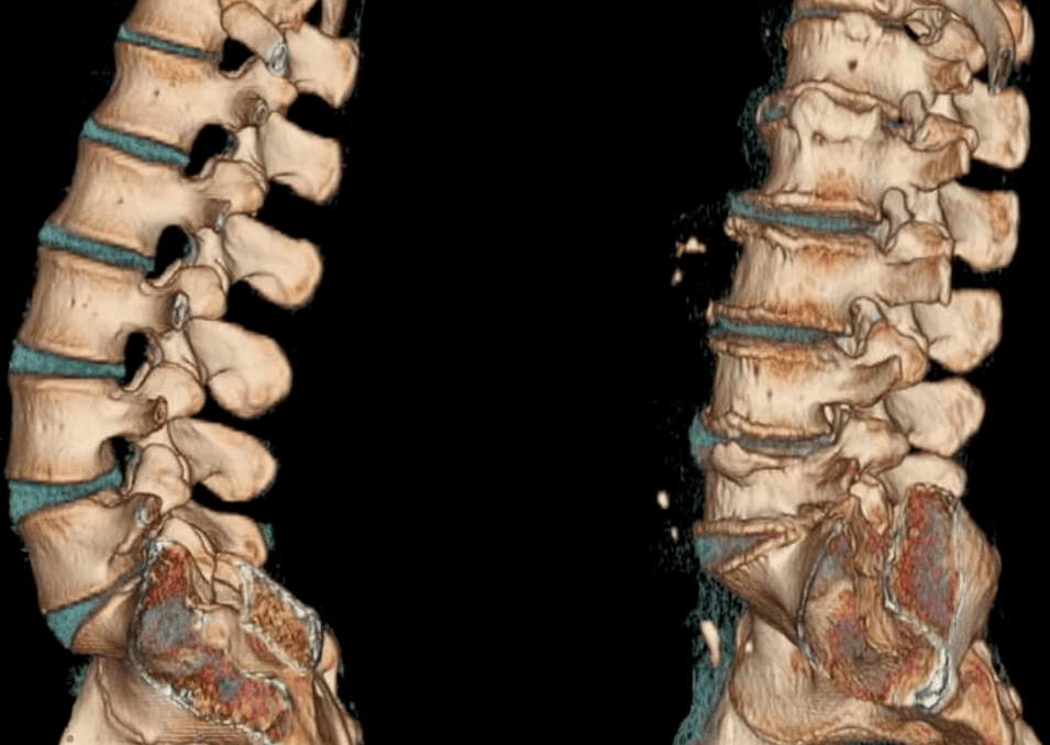osteocondrosis