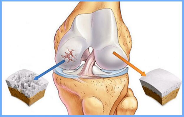 Knee joint normal and affected by osteoarthritis