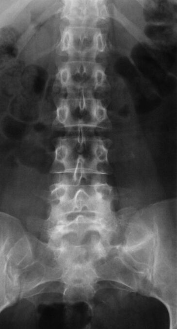 To diagnose lumbar osteochondrosis, x-ray is performed