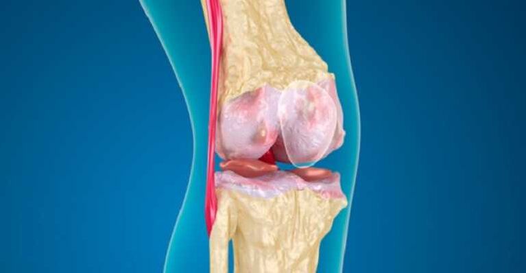 arthrosis of the knee joint disease, which causes the destruction of the cartilage in the joints