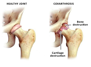 the comparison of healthy joints and zustavas of the hip